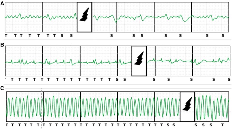 Answer: Three thunderclaps in a quiescent myocardium.