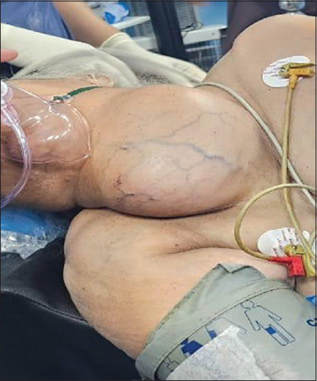 Fiberoptic intubation in the lateral position in emergency airway management of a patient with large thyroid swelling.