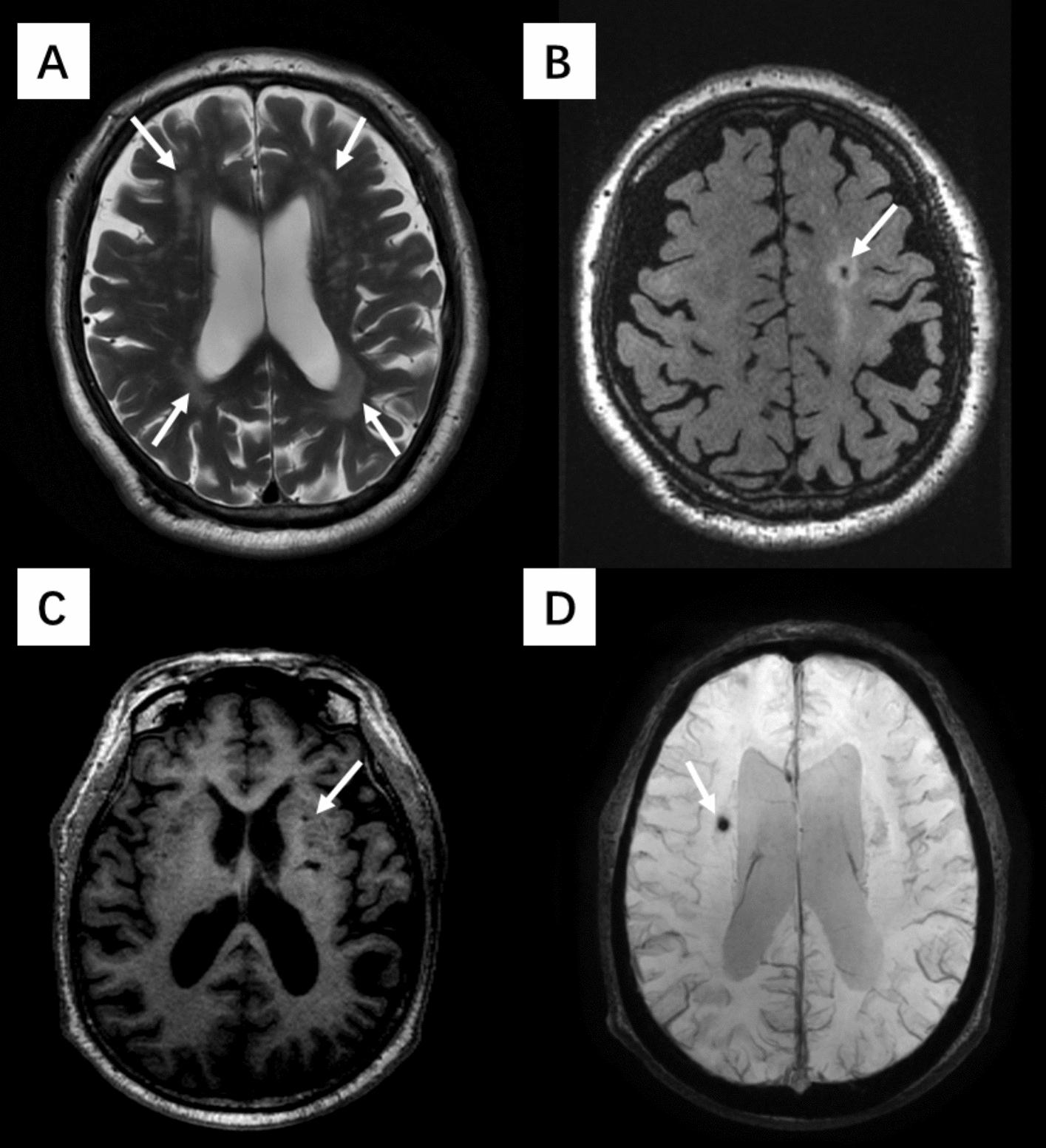 Associations of carotid flow velocity with cerebral perfusion and cerebral small vessel disease: a community-based prospective study.
