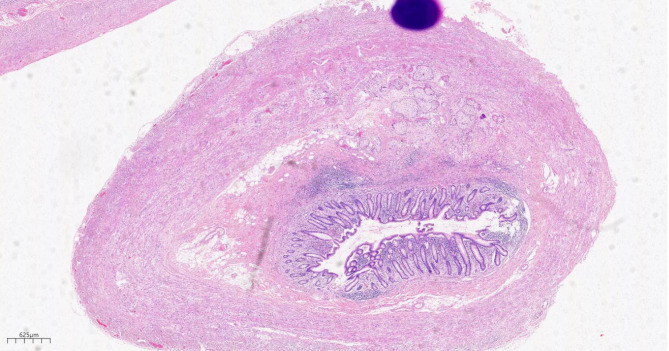 Rare double primary carcinoma in ileocecal region: cecal tubular adenocarcinoma combined with appendiceal goblet cell adenocarcinoma.