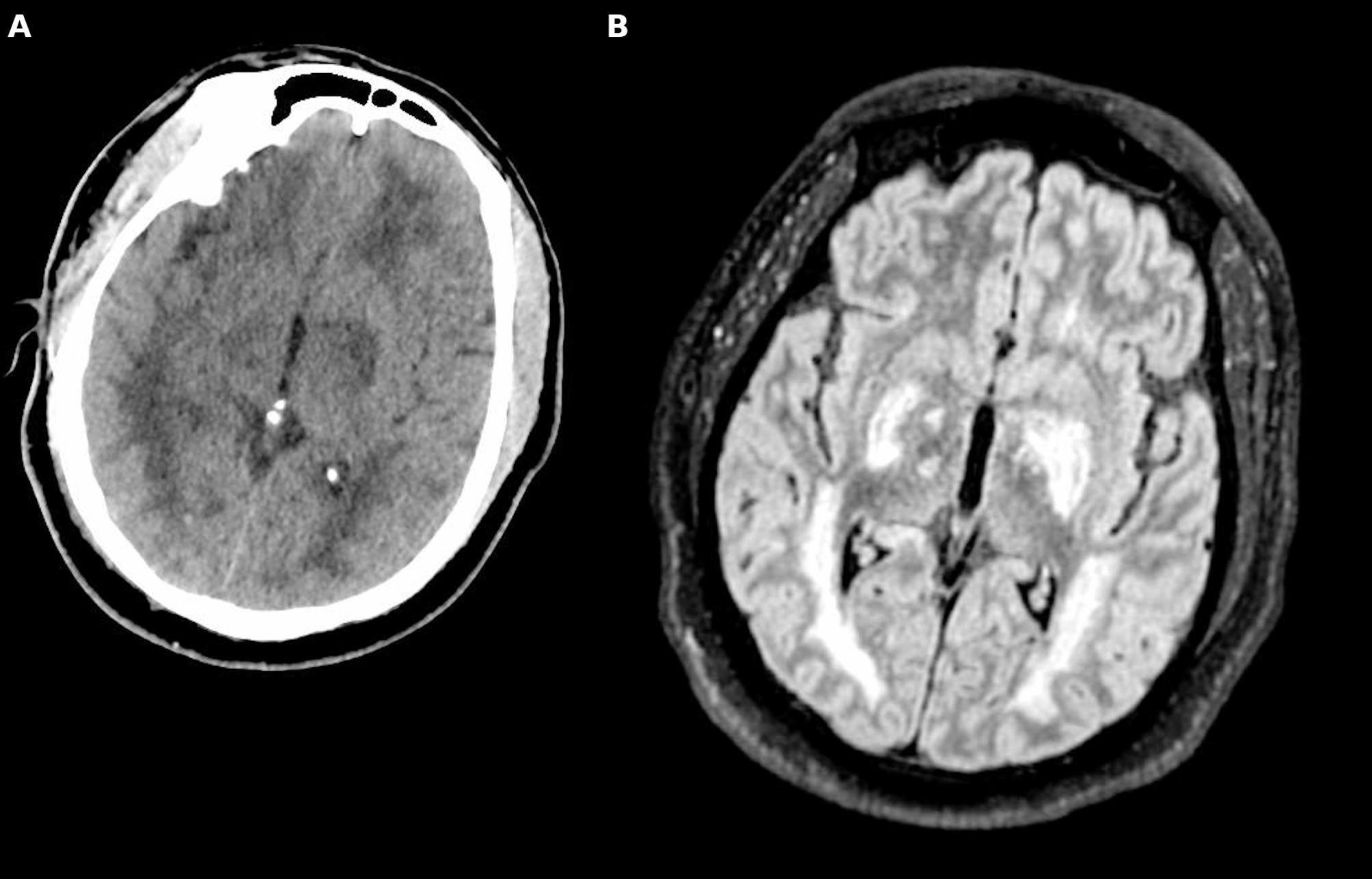 Management and monitoring strategies for severe cerebral malaria: a guide for the intensivist.