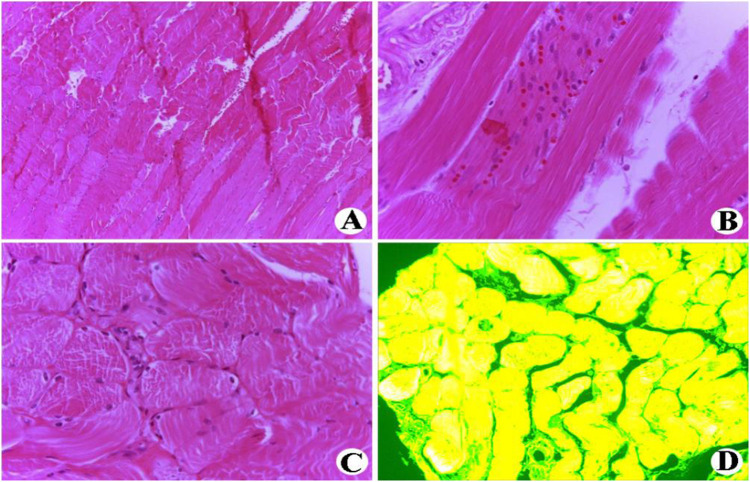 A Rare Case Report of Dermatomyositis Accompanied by Blisters.