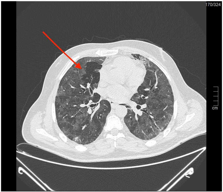The Predictive Power of Barotrauma from the Macklin Effect in the ARDS Population: A Comparison of COVID-19 and Non-COVID-19 ARDS-Could the Macklin Effect Serve as a Helpful Tool for Evaluating Transfer to ARDS Reference Centers?