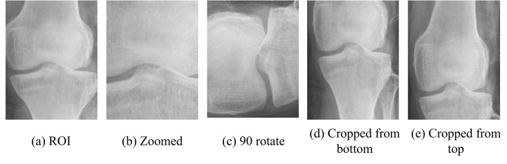 BONE-Net: A novel hybrid deep-learning model for effective osteoporosis detection.