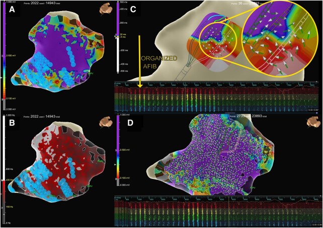 Robotic Hybrid Ablation with Novel Epicardial Electrophysiological Mapping: Impact on Atrial Fibrillation Therapy.