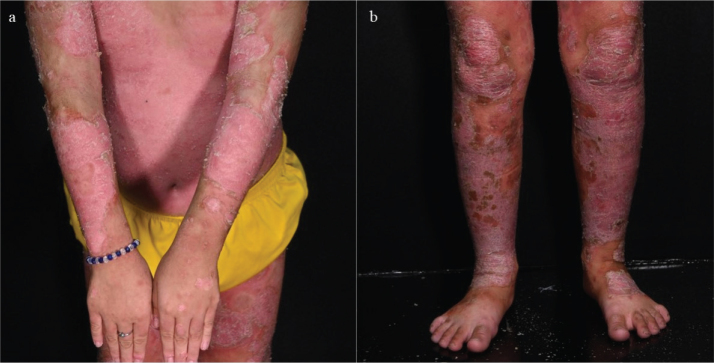 A Seven-year-old Girl with Exfoliative Erythroderma: A Quiz.