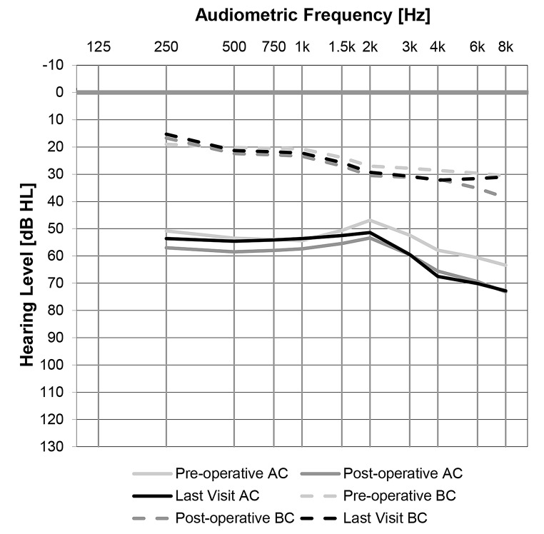 Long-term outcomes of tympanoplasty with persistent air-bone gap in adults with chronic otitis media: hearing, health care utilization and quality of life.