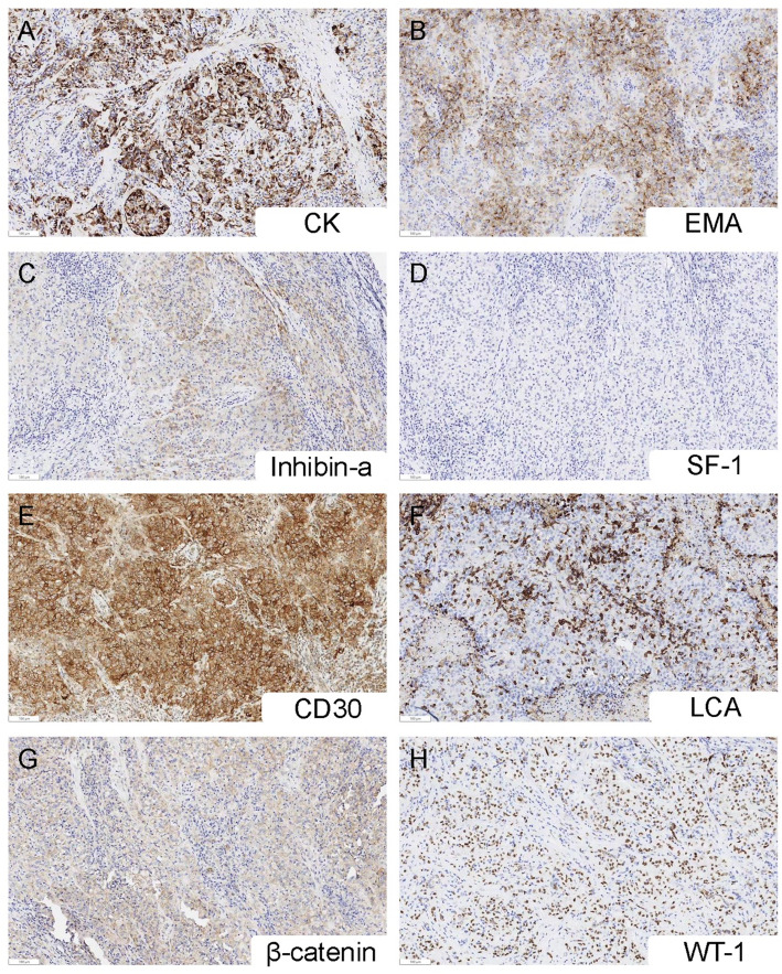Clinicopathological characteristics and molecular genetic analysis of inflammatory and nested testicular sex cord tumor: a case report and literature review.