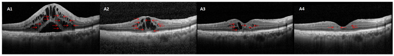 Hyperreflective Dots on SD-OCT: Implications for Predicting Treatment Outcomes in Diabetic Macular Edema.