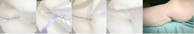 No clinical differences between outside-in and all-inside techniques in medial meniscus repair: emphasizing Minimal Clinically Important Difference (MCID) -based outcomes.