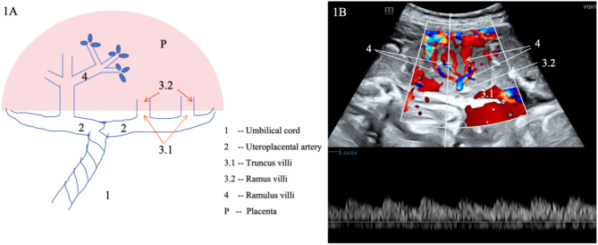 Prediction of preeclampsia by evaluating the RI of placental second villi in the third trimester with HR-Flow ultrasound.