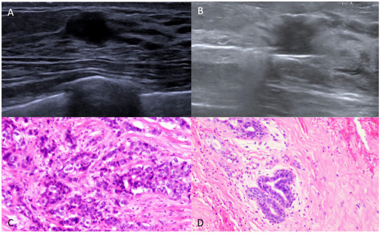 Factors Correlated with Post-Surgery Residual Carcinoma in Cases of Breast Cancer Incidentally Found via Vacuum-Assisted Excision: An Ultrasound Perspective.