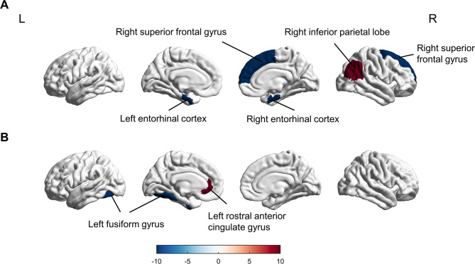 BDNF genotype associated with changes in cortical thickness, severity of symptoms, and cognitive impairments in mild traumatic brain injury.