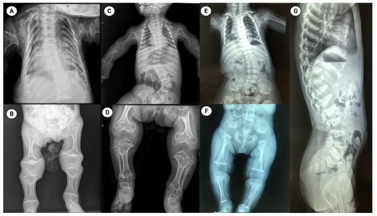 The Broad Clinical Spectrum of Metatropic Dysplasia: A Case Series and Literature Review.