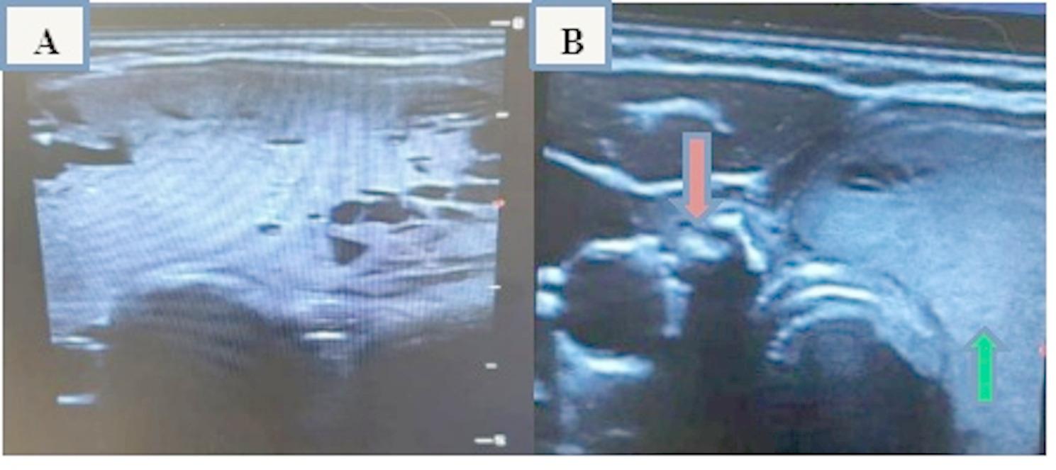 Right thyroid hemiagenesis presenting with a contralateral simple diffuse goiter: case report.