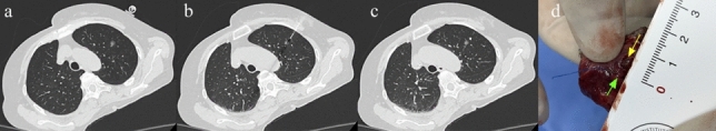 Preliminary clinical experience with a robot-assisted system in preoperative hookwire localization of pulmonary nodules: a prospective pilot study.