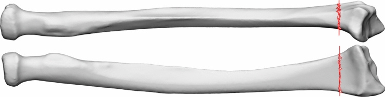 A shape completion model for corrective osteotomy of distal radius malunion.