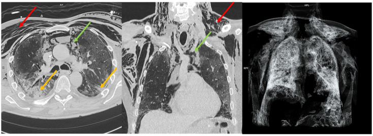 The Predictive Power of Barotrauma from the Macklin Effect in the ARDS Population: A Comparison of COVID-19 and Non-COVID-19 ARDS-Could the Macklin Effect Serve as a Helpful Tool for Evaluating Transfer to ARDS Reference Centers?