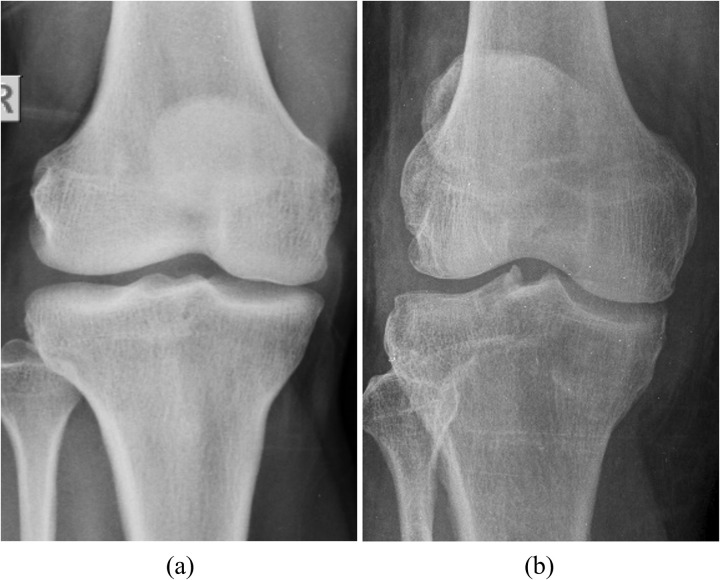 BONE-Net: A novel hybrid deep-learning model for effective osteoporosis detection.