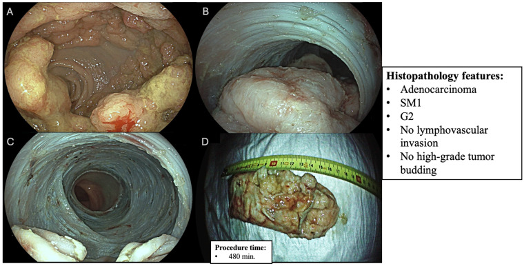 Outcomes of Endoscopic Resection of Circumferential Colorectal Laterally Spreading Lesions: A Western Experience.