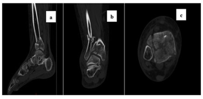 The Influence of Preoperative Central Sensitization on the Postoperative Prognosis of Pilon Fractures: A Retrospective Study.