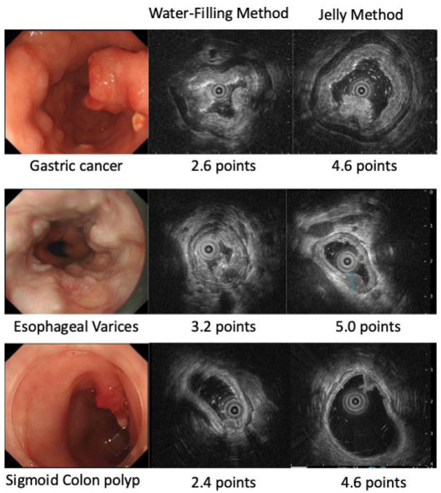 Utility of oral rehydration jelly in probe method endoscopic ultrasound: a prospective cohort study.