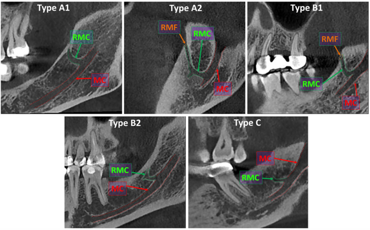 Investigation of the Prevalence and Characteristics of the Retromolar Canal Using Cone-Beam Computed Tomography in a Turkish Sample.