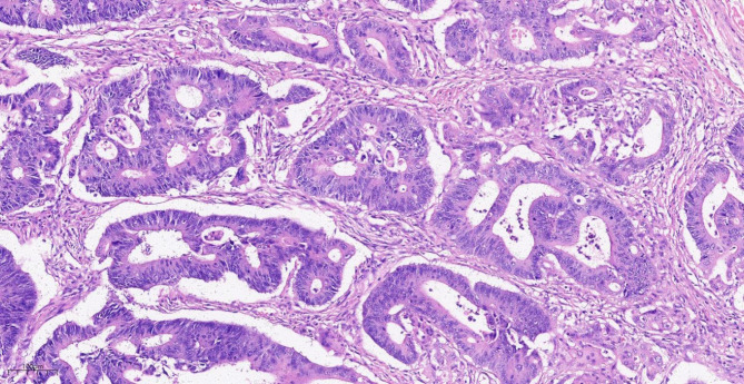 Rare double primary carcinoma in ileocecal region: cecal tubular adenocarcinoma combined with appendiceal goblet cell adenocarcinoma.