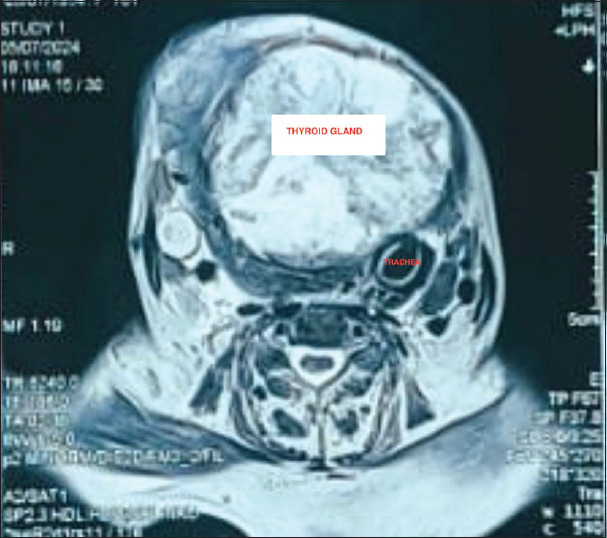 Fiberoptic intubation in the lateral position in emergency airway management of a patient with large thyroid swelling.