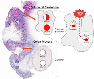 The subcellular distribution of phosphorylated Y-box-binding protein-1 at S102 in colorectal cancer patients, stratified by KRAS mutational status and clinicopathological features.