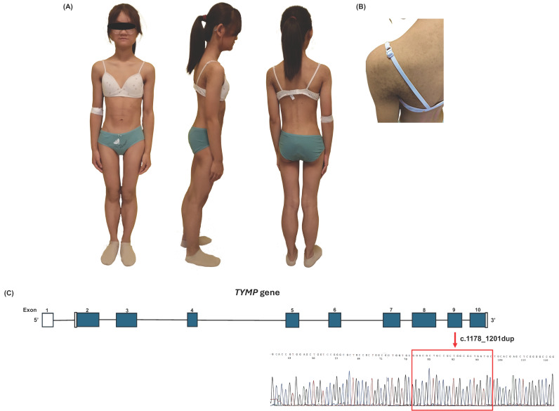 Expansion of the Phenotypic Spectrum of MNGIE: Lipodystrophy and Metabolic Alterations Associated with a p.Arg393_Val400dup TYMP Variant.