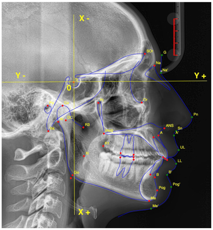 Reproducibility of AI in Cephalometric Landmark Detection: A Preliminary Study.