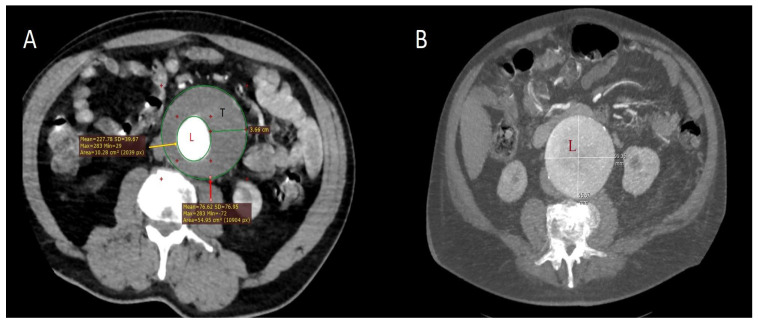 Inflammation-Based Cell Ratios Beyond White Blood Cell Count for Predicting Postimplantation Syndrome After EVAR and TEVAR.