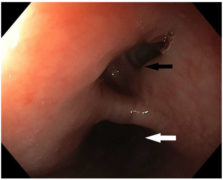 Endoscopic Repair of Tracheoesophageal Fistula with Vascular Embolization Plug.