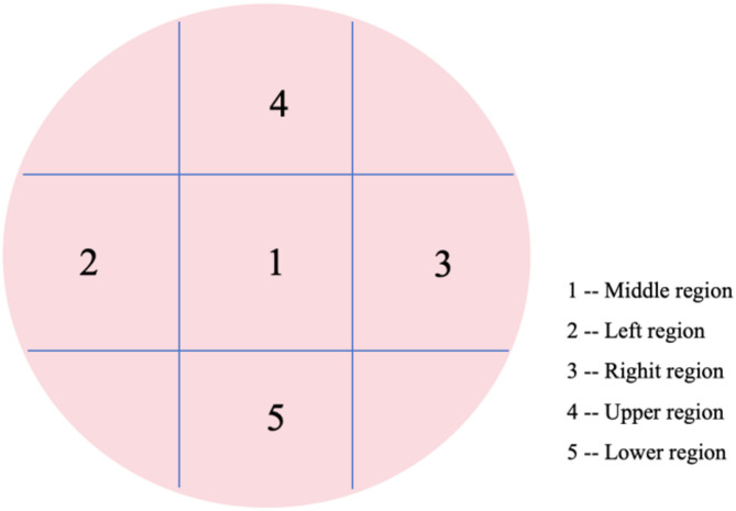 Prediction of preeclampsia by evaluating the RI of placental second villi in the third trimester with HR-Flow ultrasound.