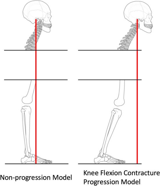 Predictors of flexion contracture progression following total knee arthroplasty: role of global sagittal alignment and patient age.