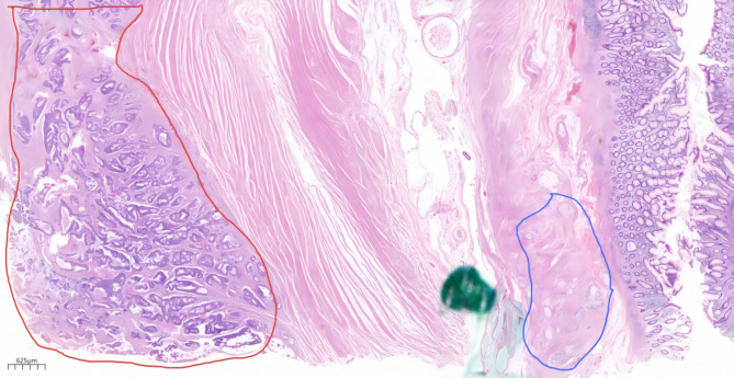 Rare double primary carcinoma in ileocecal region: cecal tubular adenocarcinoma combined with appendiceal goblet cell adenocarcinoma.
