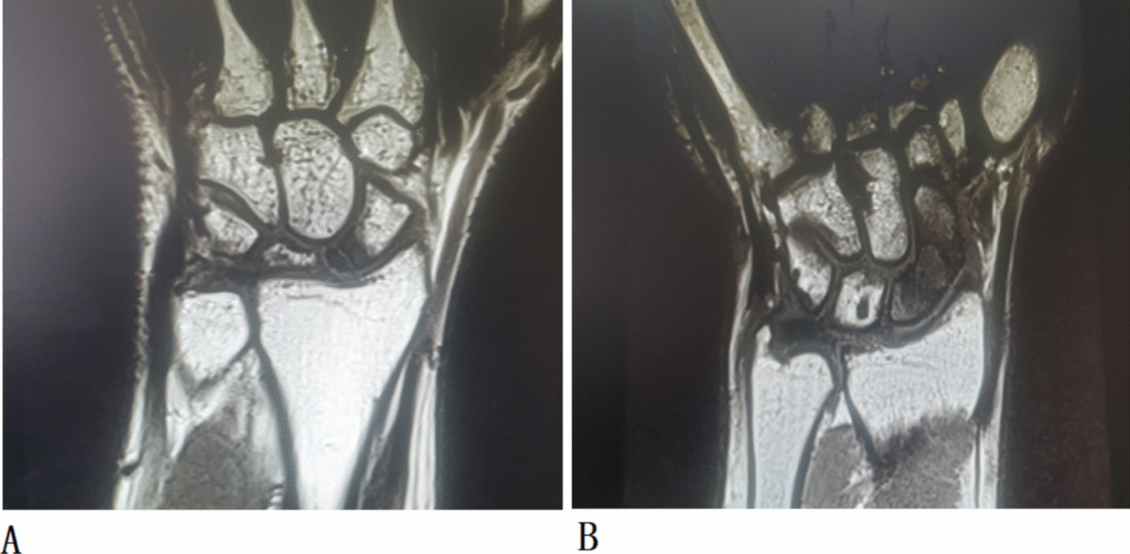 How accurate is preoperative MRI in assessing scaphoid vascularity in patients with scaphoid nonunion? A systematic review and meta-analysis.