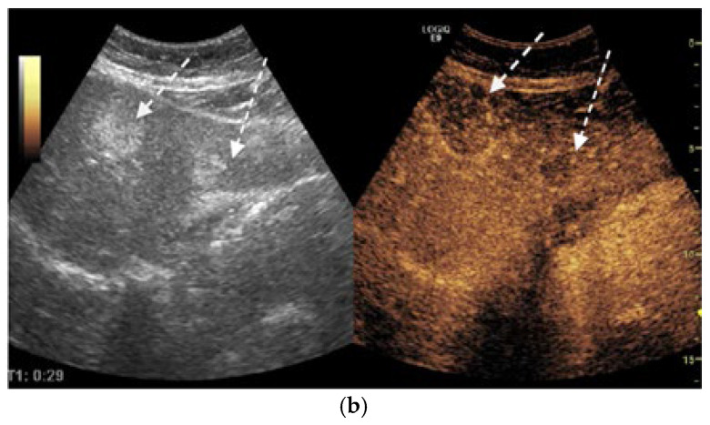 Synchronous Pulmonary and Cecal High-Grade Neuroendocrine Carcinomas Presenting as Hepatic Metastases: A Diagnostic Challenges and Literature Review.