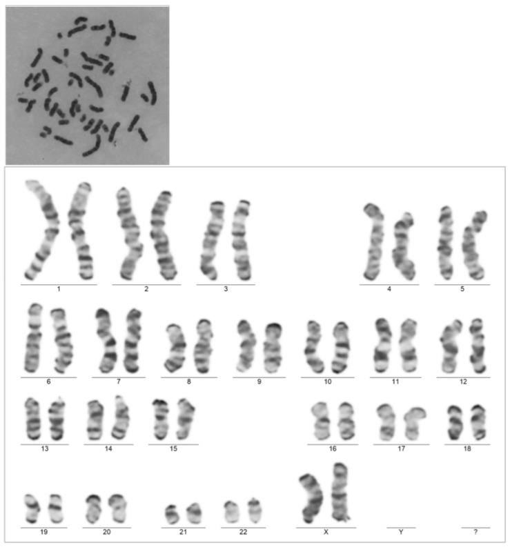 An Account of Acute Myeloid Leukemia Complicating Pregnancy and Literature Review.