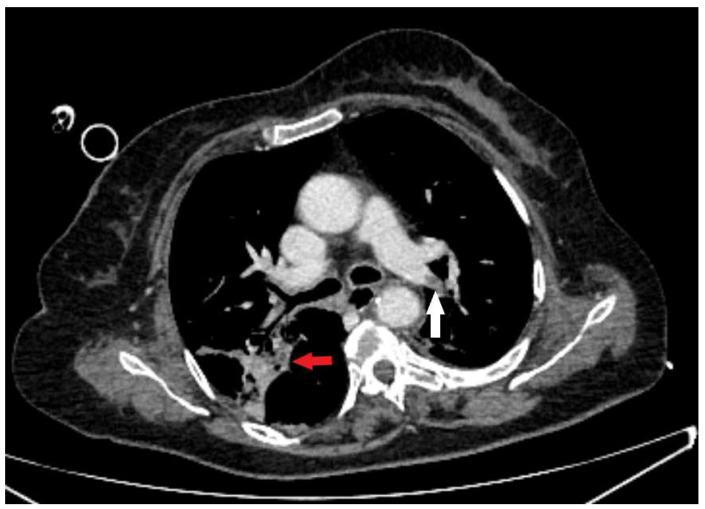 Endoscopic Repair of Tracheoesophageal Fistula with Vascular Embolization Plug.