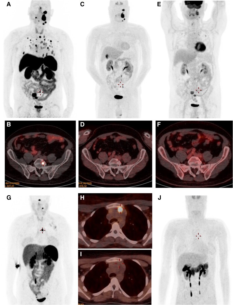 New Insights into the Clinical Characterization of SDHAF2-related Familial Paraganglioma Syndrome.