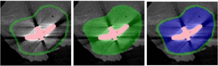 Automation in tibial implant loosening detection using deep-learning segmentation.