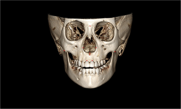 Reliability and reproducibility of CBCT assessment of craniomaxillary changes before and after treatment for Class III growing patients - a cautious or critical approach.