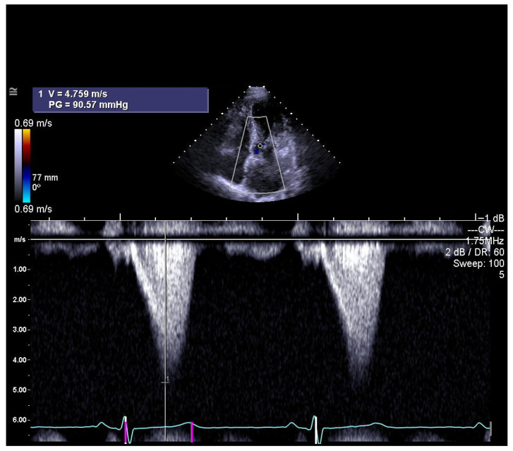 Significance of the Monitoring Right Ventricular Echocardiographic Parameters in Patients with Hypertrophic Cardiomyopathy Undergoing Alcohol Septal Ablation-A Single-Center Experience.