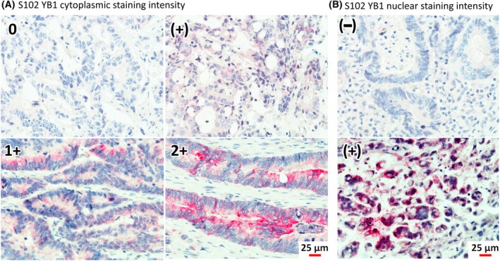 The subcellular distribution of phosphorylated Y-box-binding protein-1 at S102 in colorectal cancer patients, stratified by KRAS mutational status and clinicopathological features.