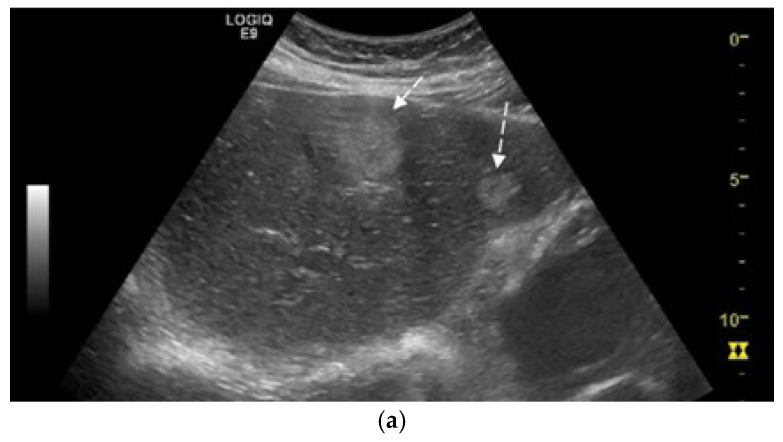 Synchronous Pulmonary and Cecal High-Grade Neuroendocrine Carcinomas Presenting as Hepatic Metastases: A Diagnostic Challenges and Literature Review.