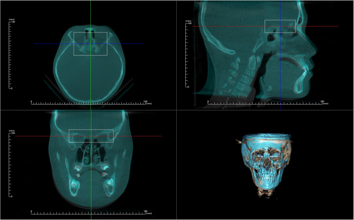 Reliability and reproducibility of CBCT assessment of craniomaxillary changes before and after treatment for Class III growing patients - a cautious or critical approach.
