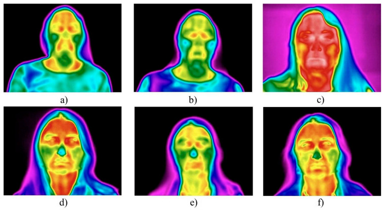Evaluation of the Effectiveness of Botulinum Therapy Based on the Anthropometric Characteristics of the Face Using Non-Invasive Thermal Imaging Data.