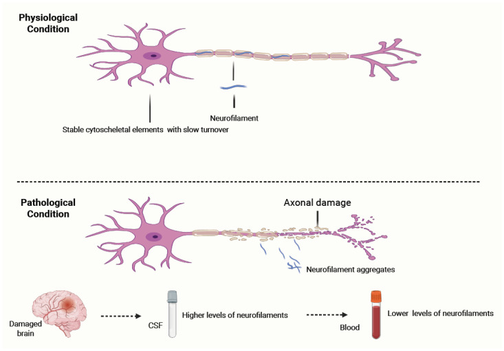 Neurofilament Biomarkers in Neurology: From Neuroinflammation to Neurodegeneration, Bridging Established and Novel Analytical Advances with Clinical Practice.